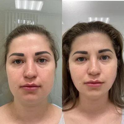 На фото пациентка «до» и «после» процедуры жидкие нити POLYDERM💉 DOCTOR  BAGAN💫 | Instagram