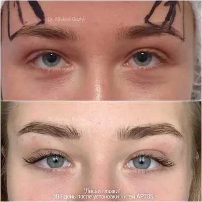 Осложнения после подтяжки нитями - Cosmetic-clinic