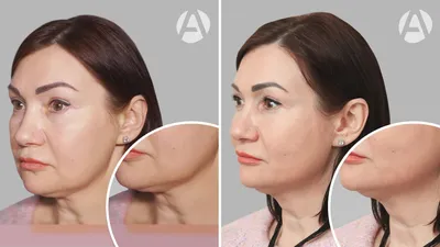 Нитевой лифтинг лица - стоимость процедуры, фото лечения до и после -  Саратов