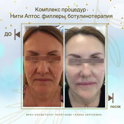 Нитевое омоложение Аптос (10 нитей Aptos Visage) ⠀ Стоимость процедуры - 60  000 т.р ⠀ 👉 Значительный результат пациенты отмечают уже… | Instagram