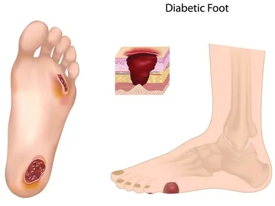 Диабетическая стопа: причины, симптомы, виды, лечение, когда нужна  ампутация, какую обувь носить