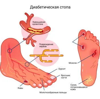 Ноги при сахарном диабете