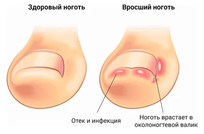 Удаление вросшего ногтя лазером - цена лечения в СПб