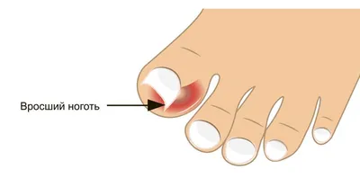 Грибок и вросший ноготь подолог | Московская Клиника Подологии