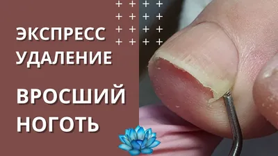 Врастание ногтя | Пикабу