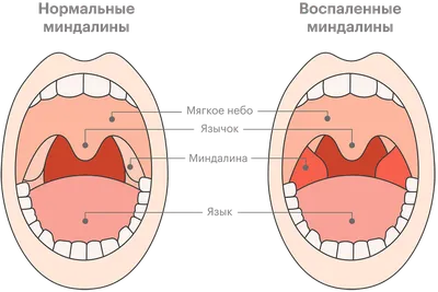 Как распознать ангину у ребёнка и что делать? Рекомендации педиатров |  Book24: блог для мамы и ребенка | Дзен
