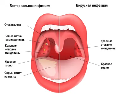 Аденоиды - Школа Кроха