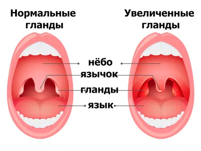 Открытый нормальный и ангина рта размножение и вирусный. Ангины фарингит и  ангина. Инфекция миндальные орехи Иллюстрация вектора - иллюстрации  насчитывающей краснота, кашлять: 190768871