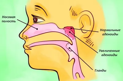 Аденоиды у детей: что это такое и как лечить?