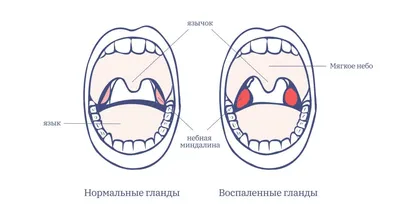 Гипертрофия небных миндалин у ребенка – симптомы, степени и лечение гланд |  «Будь Здоров»