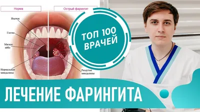 Открытый нормальный и ангина рта размножение и вирусный. Ангины фарингит и  ангина. Инфекция миндальные орехи Иллюстрация вектора - иллюстрации  насчитывающей краснота, кашлять: 190768871