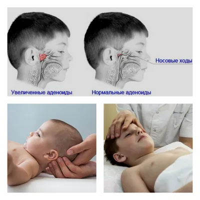 Аденоиды у ребенка симптомы и причины возникновения