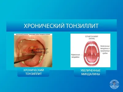 Как лечить хронический и острый тонзиллит: симптомы и препараты для  взрослых и детей