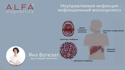 Гипертрофия небных миндалин у ребенка – симптомы, степени и лечение гланд |  «Будь Здоров»