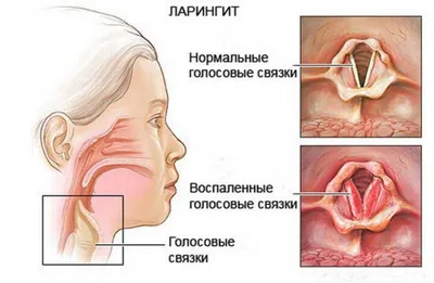 Мононуклеоз у детей – причины, симптомы и диагностика