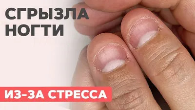 Обгрызыши! Преображение обкусанных ногтей | Как сделать маникюр на обгрызенные  ногти? - YouTube