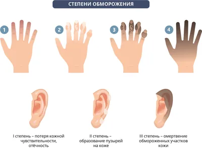 Обморожение - признаки, степени и первая помощь | Пансионаты «Забота о  близких» | Дзен