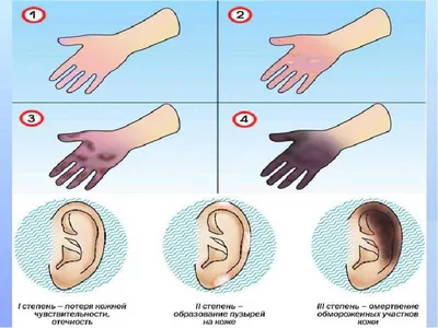Отморожение. Обморожение. Холодовая травма. Как? Что? Почему? | ДОМ ВРАЧА |  DOM VRACHA © | Дзен