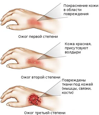 плакат Первая помощь при переохлаждении, обморожении