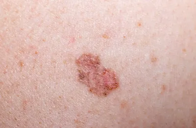 Дерматофиброма - удаление дерматофибромы кожи лазером | клиника Лазерсвiт