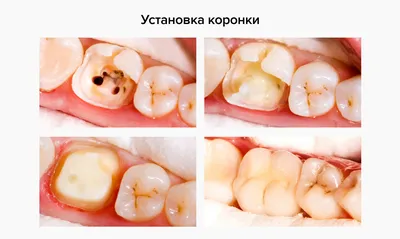 Красивая и естественная улыбка после протезирования зубов керамикой