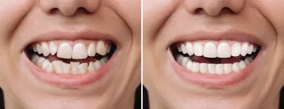 Обточенные зубы фото фотографии