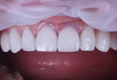 Что такое виниры? Установка виниров - Your Dentist