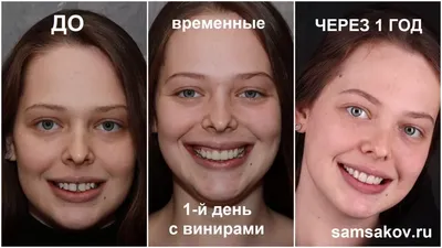 Виниры Что Это Такое 9 Фото Винировые Зубы ЛюмиДент