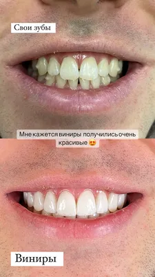 Как ставят виниры на зубы – как устанавливаются прямым и непрямым методом |  «Фактор улыбки»