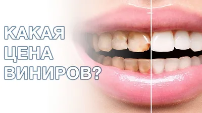 Цена на установку керамических виниров на зубы - спецпредложение со скидкой  до 50% в Москве