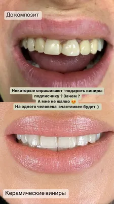 Виниры на передние зубы по цене 10 900 ₽ в СПб! - ProЗубы