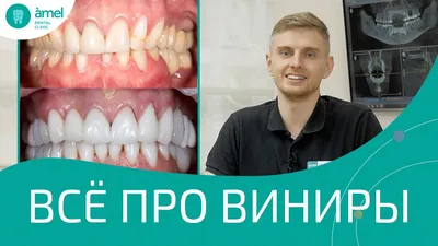 Протезирование и виниры по цифровой технологии CEREC. - Glagolev Dental  Clinic