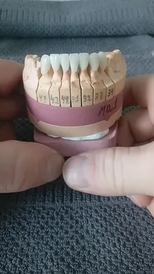 Виниры E-Max и 3D-виниры в Омске — Стоматология Элита