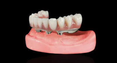 Бюгельный протез ≡ Поставить бюгель в Ирпене | MySmile®