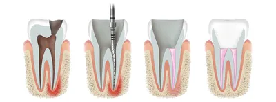 Воспаление зубного нерва - полезная информация от врачей стоматологии  доктора Фролова