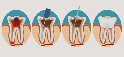 Воспаление нерва зуба: симптомы и методы лечения