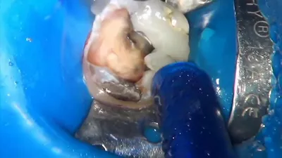 Удаление нерва, чистка каналов зуба, как выглядит зубной нерв - YouTube