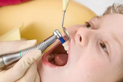 Удаление нерва в зубе у ребенка: когда необходимо, методы, последствия