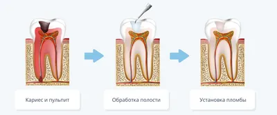 Пульпит зуба — что это такое, симптомы и методы лечения