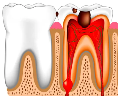Оголенный зубной нерв: методы устранения боли в домашних условиях |  za-rozhdenie.ru