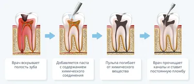 Пульпит зуба — что это такое, симптомы и методы лечения