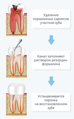 Пульпит зуба — что это такое, симптомы и методы лечения