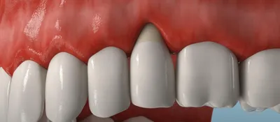 Оголение шейки (корня) зуба: что делать и как лечить