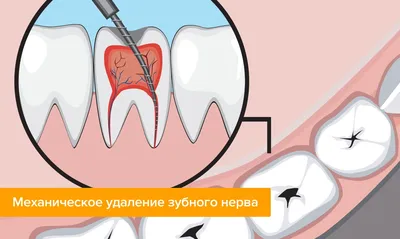 Как убить нерв в зубе: как выглядит, где находится и как можно убить зубной  нерв в домашних условиях?