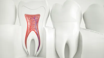 Воспаление зубного нерва - полезная информация от врачей стоматологии  доктора Фролова