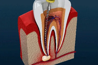 Воспаление нерва зуба: симптомы и методы лечения