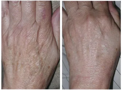 Фотографии до и после лазерного омоложения Fraxel в клинике Premium  Aesthetics, пациент 2