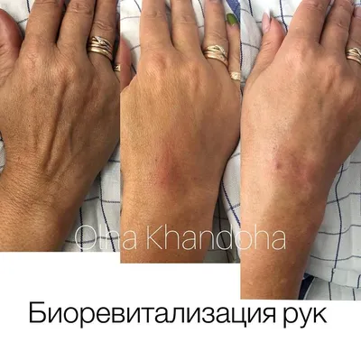 Биоревитализация рук - клиника лазерной косметологии в Москве