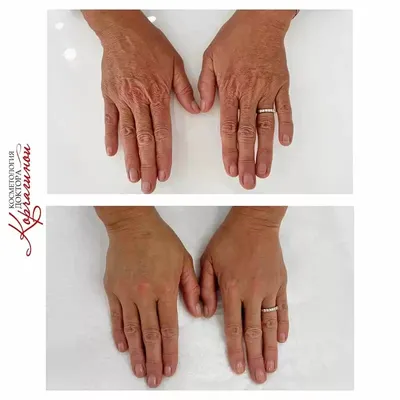 Биоревитализация – отличный способ вернуть красоту рук! | СімМед