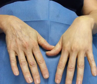 Омоложение кожи рук в Москве цена, отзывы, фото - Косметология доктора  Корчагиной